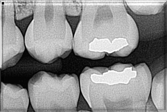 periapical x ray