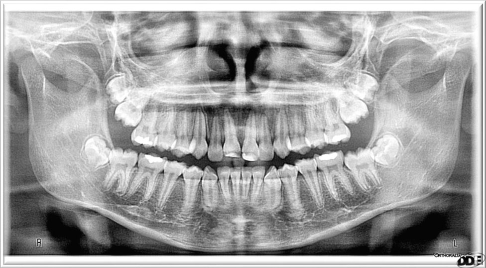 size of dental panorama x ray film