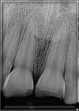 periapical-flim